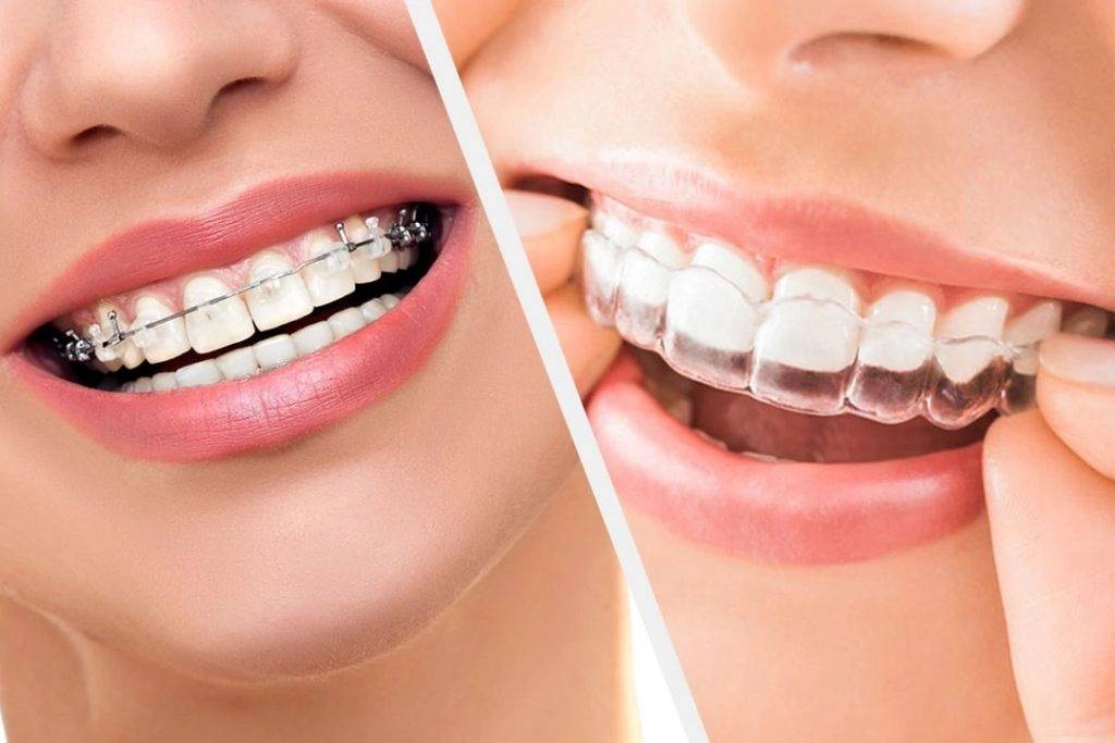 Braces and Aligners Orthodontic Treatment at AMDC