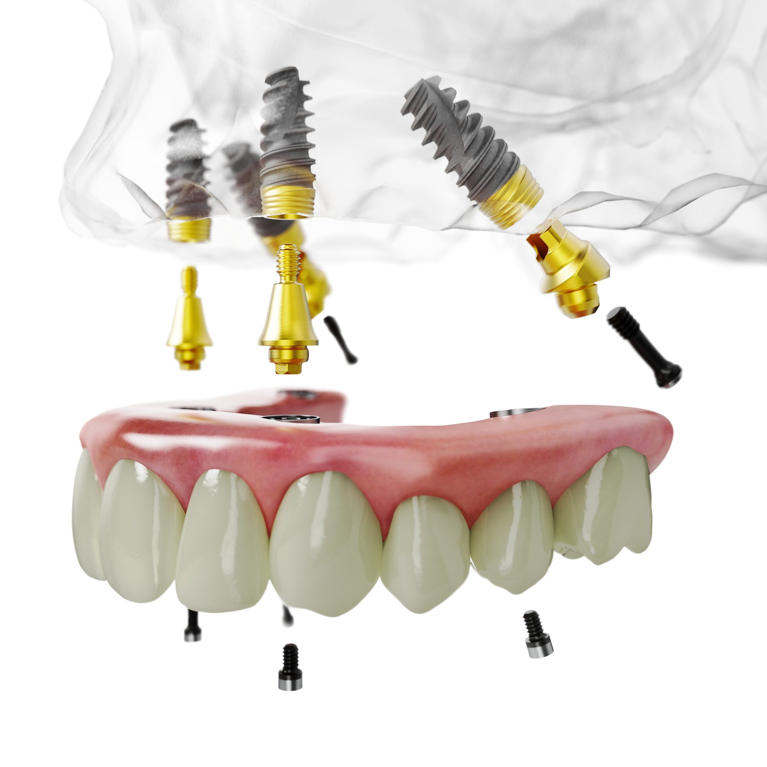 All-on-4 Implant Protocol with immediate loading prosthesis