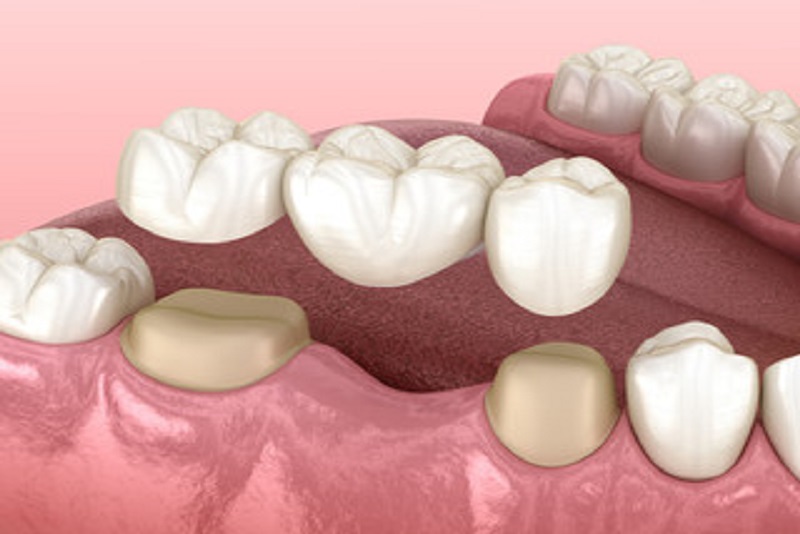 Zirconia crown, Zirconia Bridge, Lithium Disilicate crown, Li-Di Crowns, E-Max Crown